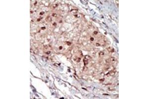 Formalin-fixed and paraffin-embedded human cancer tissue (hepatocarcinoma) reacted with the primary antibody, which was peroxidase-conjugated to the secondary antibody, followed by AEC staining. (SPHK1 anticorps  (AA 286-315))