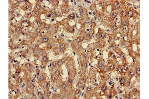 Immunohistochemistry of paraffin-embedded human liver cancer using ABIN7147936 at dilution of 1:100 (CLASP2 anticorps  (AA 226-381))