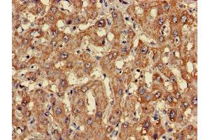 Immunohistochemistry of paraffin-embedded human liver cancer using ABIN7147936 at dilution of 1:100 (CLASP2 anticorps  (AA 226-381))
