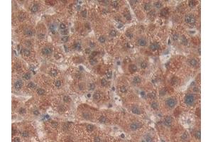 Detection of EZH2 in Human Liver cancer Tissue using Polyclonal Antibody to Enhancer Of Zeste Homolog 2 (EZH2)