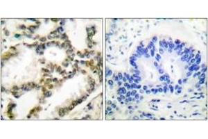 Immunohistochemistry analysis of paraffin-embedded human lung carcinoma tissue, using DJ-1 Antibody.
