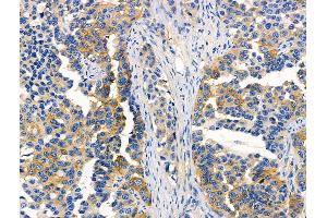 ABIN6257319 and ABIN6276046 at 1/100 staining Human lung cancer by IHC-P.