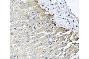 Immunohistochemistry of paraffin-embedded Human liver damage using MGAT1 Polyclonal Antibody at dilution of 1:100 (40x lens). (MGAT1 anticorps)