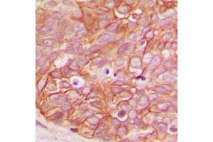 Immunohistochemical analysis of Beta-catenin (pS33) staining in human breast cancer formalin fixed paraffin embedded tissue section. (beta Catenin anticorps  (N-Term, pSer33))