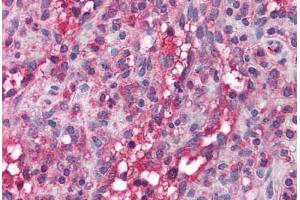 Human Spleen (formalin-fixed, paraffin-embedded) stained with APOBEC3G antibody ABIN214726 at 5 ug/ml followed by biotinylated goat anti-rabbit IgG secondary antibody ABIN481713, alkaline phosphatase-streptavidin and chromogen.