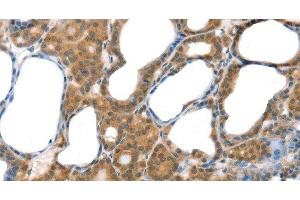 Immunohistochemistry of paraffin-embedded Human thyroid cancer tissue using Laminin alpha4 Polyclonal Antibody at dilution 1:30 (LAMa4 anticorps)