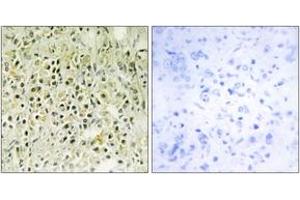 Immunohistochemistry analysis of paraffin-embedded human prostate carcinoma tissue, using LEG8 Antibody.