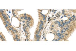 Immunohistochemistry of paraffin-embedded Human thyroid cancer tissue using STK35 Polyclonal Antibody at dilution 1:45