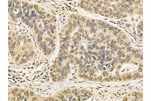 NUP50 Mouse Monoclonal Antibody at 1/100 staining human lung cancer and adjacent non-tumor tissue by IHC-P. (NUP50 anticorps)