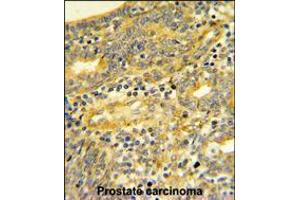 DPP8 Antibody IHC analysis in formalin fixed and paraffin embedded human Prostate carcinoma followed by peroxidase conjugation of the secondary antibody and DAB staining. (DPP8 anticorps  (C-Term))
