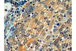 IHC-P analysis of Human Endometrial cancer Tissue, with DAB staining. (HSPA1L anticorps  (AA 1-641))