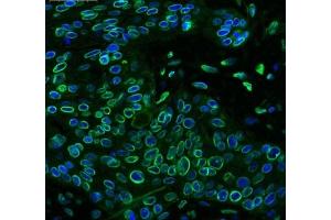 IHC testing of FFPE human lung cancer tissue with Emerin antibody at 1ug/ml.