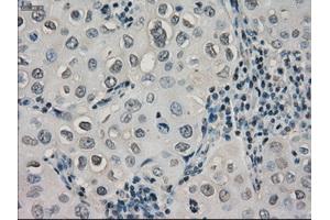 Immunohistochemical staining of paraffin-embedded Adenocarcinoma of ovary tissue using anti-CRYABmouse monoclonal antibody. (CRYAB anticorps)