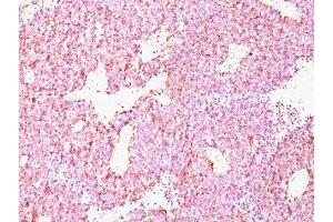 Formalin-paraffin human SC lung carcinoma stained with Chromogranin A antibody (CHGA/798) (Chromogranin A anticorps)