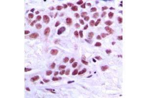 Immunohistochemical analysis of TRAP220 staining in human breast cancer formalin fixed paraffin embedded tissue section.
