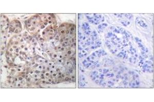 Immunohistochemistry analysis of paraffin-embedded human breast carcinoma, using STAT5A/B (Phospho-Ser725/730) Antibody. (STAT5 A/B anticorps  (pSer726))