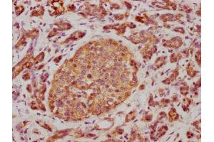 IHC image of ABIN7147175 diluted at 1:500 and staining in paraffin-embedded human lung cancer tissue performed on a Leica BondTM system.