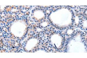 Immunohistochemistry of paraffin-embedded Human thyroid cancer using HCN1 Polyclonal Antibody at dilution of 1:50 (HCN1 anticorps)