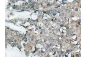 Immunohistochemistry analyzes of MEK1/2 antibody in paraffin-embedded human breast carcinoma tissue. (MEK1 anticorps)