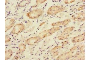 Immunohistochemistry of paraffin-embedded human gastric cancer using ABIN7166195 at dilution of 1:100