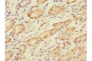 Immunohistochemistry of paraffin-embedded human gastric cancer using ABIN7166195 at dilution of 1:100 (TOB2 anticorps  (AA 1-70))