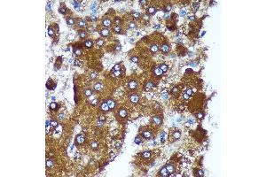 Immunohistochemistry of paraffin-embedded Human liver cancer using PIGU Rabbit pAb (ABIN7269291) at dilution of 1:100 (40x lens).