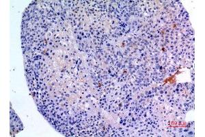 Immunohistochemistry (IHC) analysis of paraffin-embedded Human Liver Cancer, antibody was diluted at 1:100. (BMP3 anticorps  (C-Term))