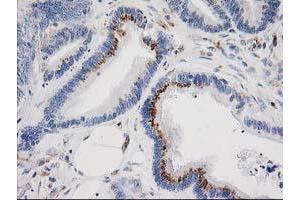 Immunohistochemical staining of paraffin-embedded Adenocarcinoma of Human colon tissue using anti-IRF6 mouse monoclonal antibody.