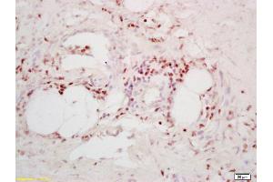 Formalin-fixed and paraffin embedded human colon carcinoma labeled with Anti-TPD52/Prostate and colon associated protein Polyclonal Antibody, Unconjugated (ABIN720745) at 1:200 followed by conjugation to the secondary antibody and DAB staining (TPD52 anticorps  (AA 141-190))