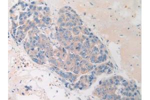 IHC-P analysis of Human Breast cancer Tissue, with DAB staining. (HAND1 anticorps  (AA 1-215))
