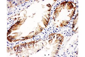 Anti-Integrin beta 4 Picoband antibody,  IHC(P): Human Intestinal Cancer Tissue