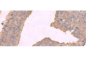 Immunohistochemistry of paraffin-embedded Human liver cancer tissue using KCNN2 Polyclonal Antibody at dilution of 1:65(x200) (KCNN2 anticorps)