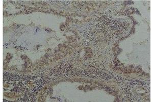 Immunohistochemical analysis of paraffin-embedded Human Lung Caricnoma using Phosphoserine Mouse mAb diluted at 1:200. (Phosphoserine anticorps)