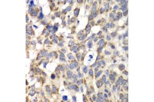 Immunohistochemistry of paraffin-embedded human esophageal cancer using PARN antibody. (PARN anticorps)