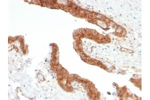 Formalin-fixed, paraffin-embedded human Prostate Carcinoma stained with CD73 Mouse Monoclonal Antibody (NT5E/2503).