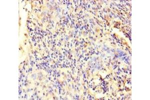 Immunohistochemistry of paraffin-embedded human cervical cancer using ABIN7151766 at dilution of 1:100 (ECEL1 anticorps  (AA 425-775))