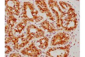 IHC image of ABIN7127347 diluted at 1:160 and staining in paraffin-embedded human breast cancer performed on a Leica BondTM system.