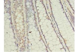 Immunohistochemistry of paraffin-embedded human colon cancer using ABIN7174430 at dilution of 1:100