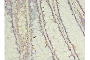 Immunohistochemistry of paraffin-embedded human colon cancer using ABIN7174430 at dilution of 1:100 (UBE2C anticorps  (AA 2-179))
