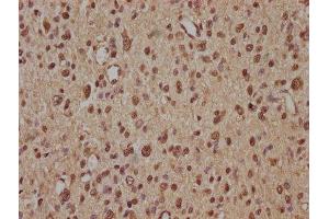 IHC image of ABIN7140239 diluted at 1:100 and staining in paraffin-embedded human glioma performed on a Leica BondTM system. (Znf423 anticorps  (AA 39-57))