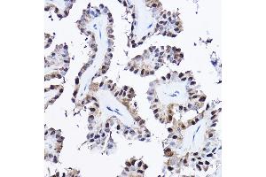 Immunohistochemistry of paraffin-embedded human thyroid cancer using [KO Validated] PDCD4 Rabbit pAb (ABIN3023387, ABIN3023388, ABIN3023389 and ABIN1681284) at dilution of 1:25 (40x lens). (PDCD4 anticorps  (AA 1-260))