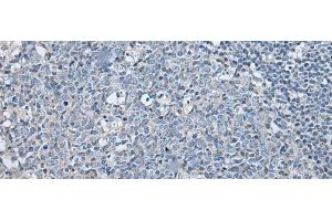 Immunohistochemistry of paraffin-embedded Human tonsil tissue using LASP1 Polyclonal Antibody at dilution of 1:35(x200) (LASP1 anticorps)