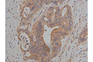 ABIN6269036 at 1/200 staining human colon cancer tissue sections by IHC-P.