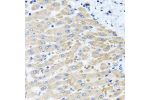 Immunohistochemistry of paraffin-embedded human liver injury using DARS2 antibody.