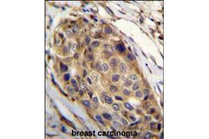 SSH3 Antibody immunohistochemistry analysis in formalin fixed and paraffin embedded human breast carcinoma followed by peroxidase conjugation of the secondary antibody and DAB staining. (SSH3 anticorps  (C-Term))