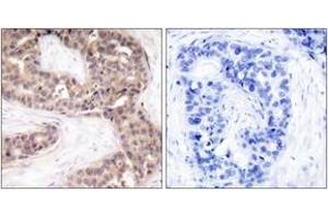 Immunohistochemistry analysis of paraffin-embedded human breast carcinoma tissue, using G3BP-1 (Ab-232) Antibody. (G3BP1 anticorps  (AA 199-248))