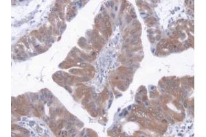 Detection of AST in Human Liver cancer Tissue using Polyclonal Antibody to Aspartate Aminotransferase (AST)