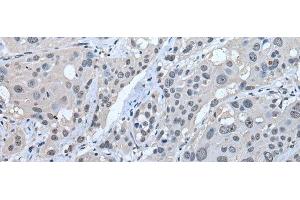 Immunohistochemistry of paraffin-embedded Human esophagus cancer tissue using STRADA Polyclonal Antibody at dilution of 1:45(x200) (STRADA anticorps)