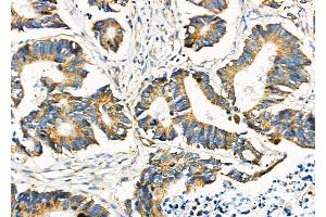 ABIN6260901 and ABIN6276686 at 1/100 staining Human colorectal cancer by IHC-P. (Clusterin anticorps  (Internal Region))