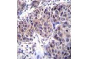 Formalin fixed and paraffin embedded human breast carcinoma reacted with Dishevelled-3 / DVL3 Antibody (C-term) followed by peroxidase conjugation of the secondary antibody and DAB staining.